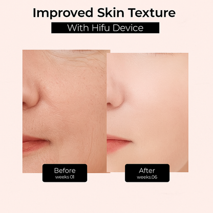 Hifu Anti Wrinkle Device